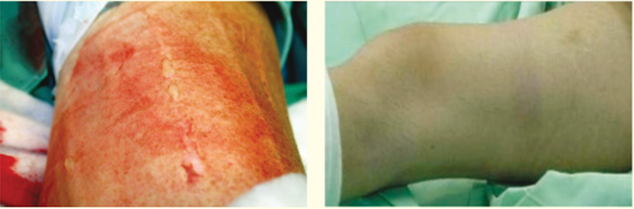 【生理學(xué)和生物學(xué)】Surgical Tourniquets in Orthopaedics